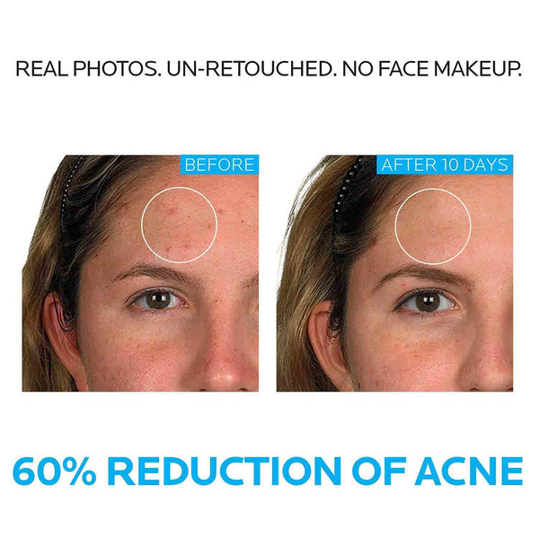 KIT DE 3 PASOS PARA EL ACNE